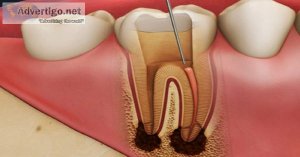 Painless root canal treatment in pune, pimpri-chinchwad | afford