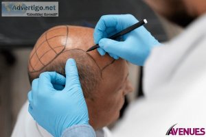 Fue hair transplant cost in ahmedabad, india