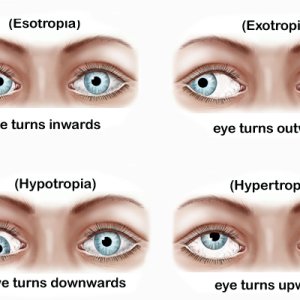 Best squint in eyes treatment available in delhi