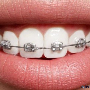 what are power chains for braces