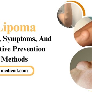 Lipoma causes, symptoms, and effective prevention methods