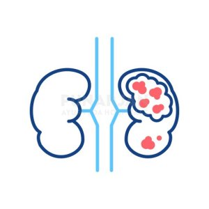 Best kidney cancer treatment hospitals in hyderabad