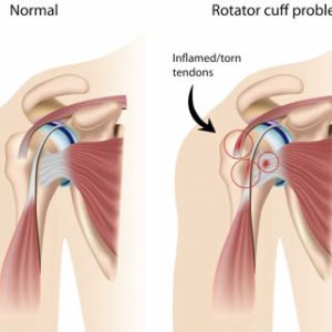 Rotator cuff tear treatment in delhi