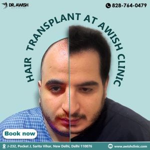 Hair transplant clinic in delhi ncr