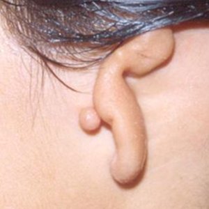 Ear reconstruction surgery- the microtia trust