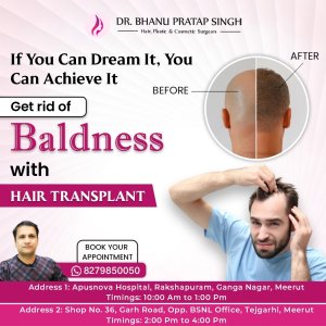 Best hair transplant in ncr