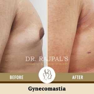 Gynecomastia surgery in delhi: it s a permanent treatment?