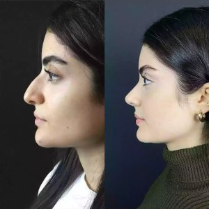 Best nose job in abu dhabi