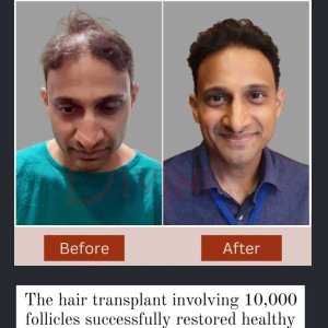 Hair transplant in delhi with best plastic surgeon