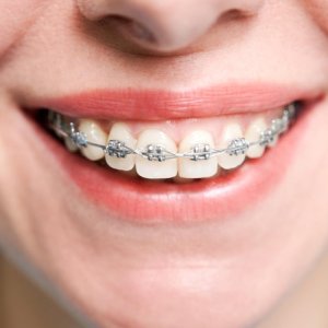 Dental implants in abu dhabi