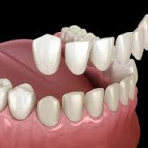 Dental veneers abudhabi