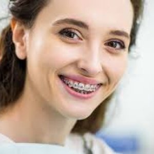 Braces adjustment in abudhabi