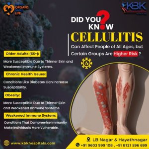 Cellulitis treatment | kbk multispeciality hospitals