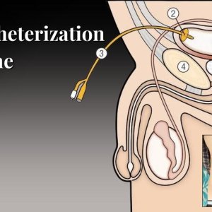 Suprapubic catheterization procedure: a comprehensive guide