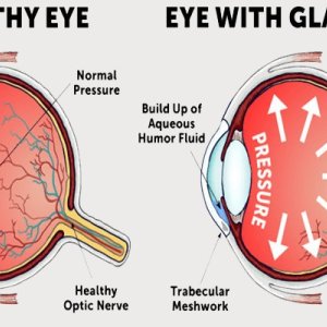 Glaucoma treatment in mumbai