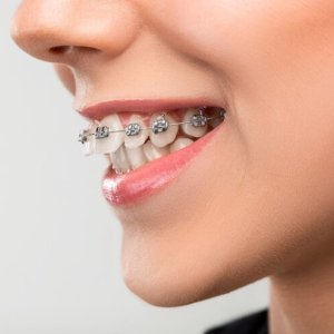 Braces in fort worth