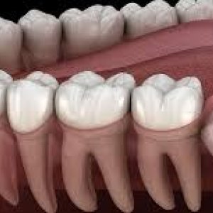 Tooth removal cost in abudhabi