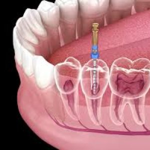 Root canal treatment in abudhabi