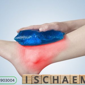 Acute limb ischemia treatment in hyderabad | dr rahul agarwal