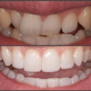 Why should you straighten teeth without braces?