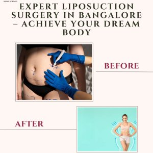 Expert liposuction surgery in bangalore