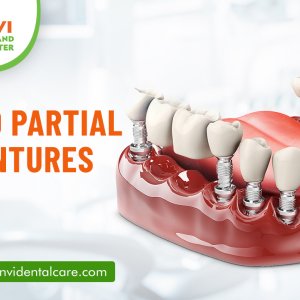 Fixed partial dentures vivekananda nagar