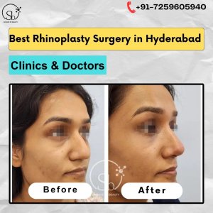 Best rhinoplasty surgery in hyderabad | clinics & doctors