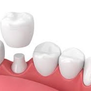 Dental crowns in abudhabi