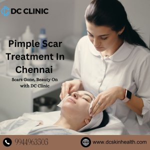 Acne treatment in chennai