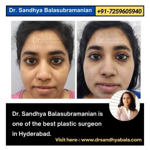 Top dermal fillers in hyderabad for youthful skin