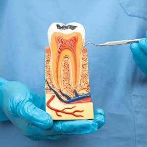 Root canal treatment in gurgaom