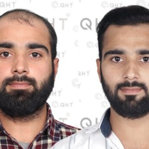 Qht hair transplant clinic hyderabad