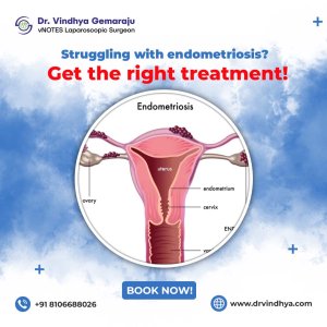 Best endometriosis treatment in hyderabad | dr vindhya gemaraju