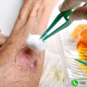 Diabetic wound care specialist in hyderabad | vascularhyd