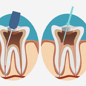 Best root canal treatment in zirakpur